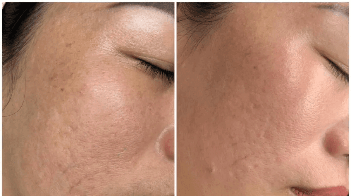 Điều trị sẹo rỗ tại HBIO Clinic