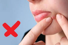 Hạn chế tự ý nặn mụn