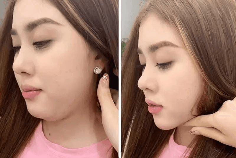 Hiệu quả sau khi thực hiện tiêm tan mỡ vùng má