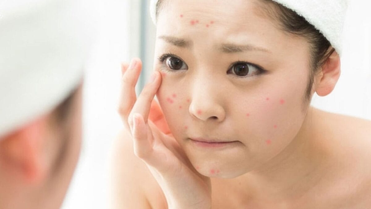 Không nặn mụn có bị rỗ không?