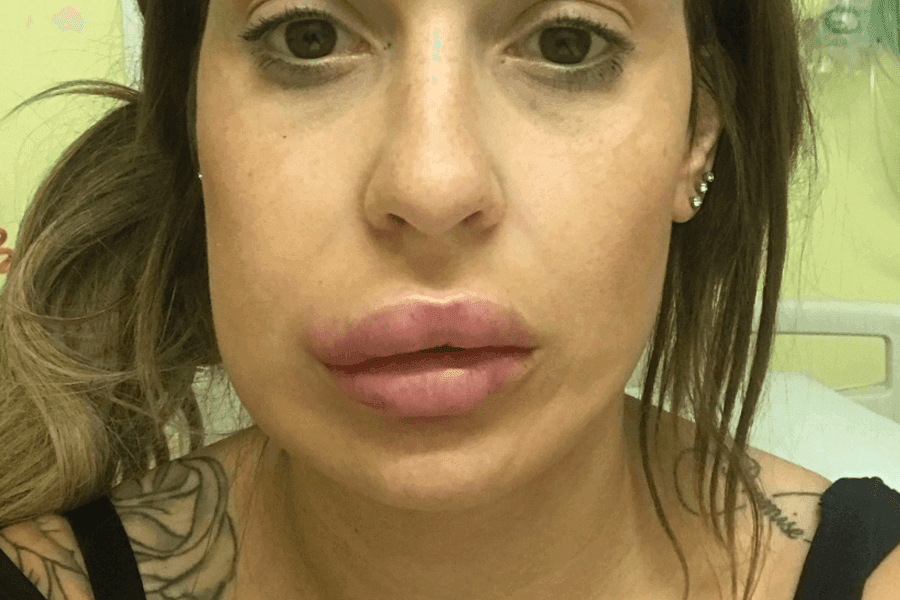 Causes of filler injection necrosis