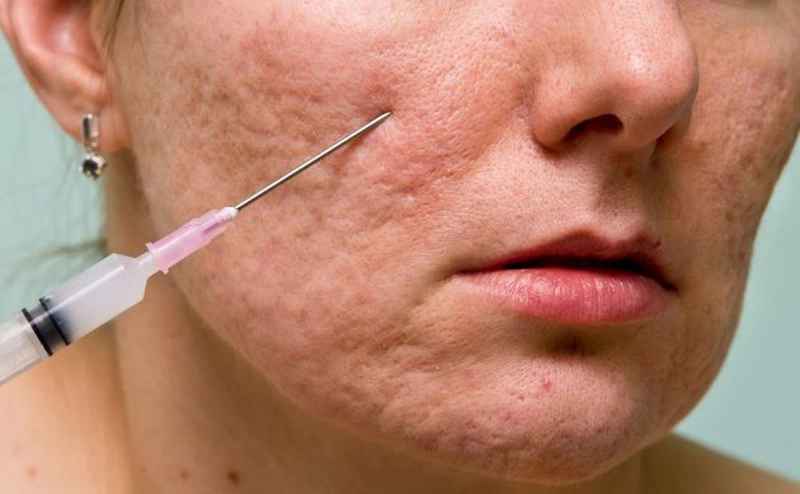 Quy trình thực hiện cắt đáy các vết sẹo
