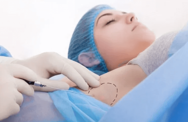 Quy trình thực hiện tiêm botox nách tại HBIO Clinic