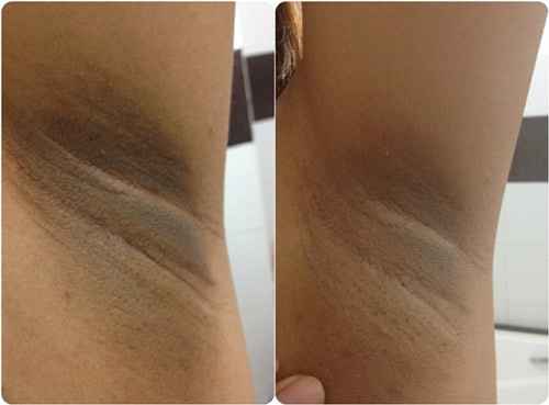 Tại sao khi mang thai nách lại bị thâm