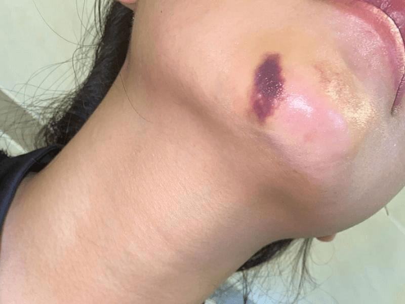 Tiêm filler môi bị bầm có nguy hiểm không?