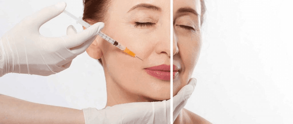Filler dissolving injection is applied when the initial filler injection is not effective.