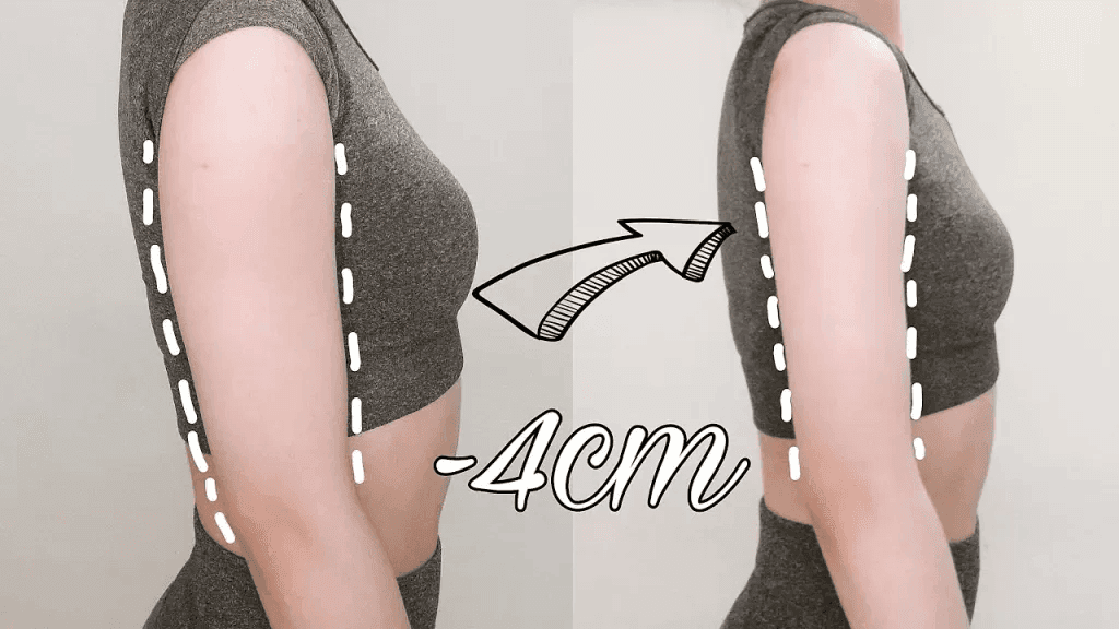 Tiêm thon gọn bắp tay là gì?