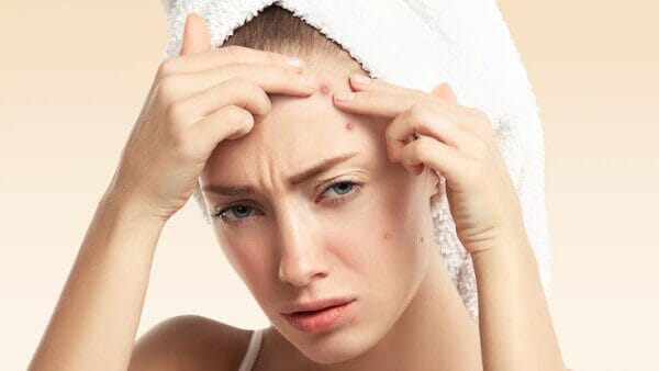 Tình trạng bị rỗ sau khi nặn mụn do đâu?