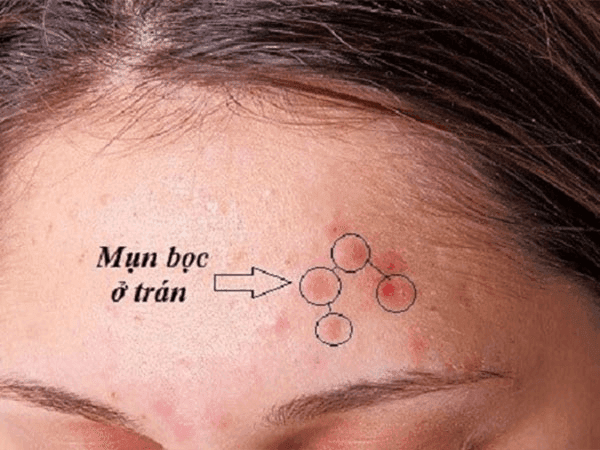 Vật dụng cọ sát vùng trán