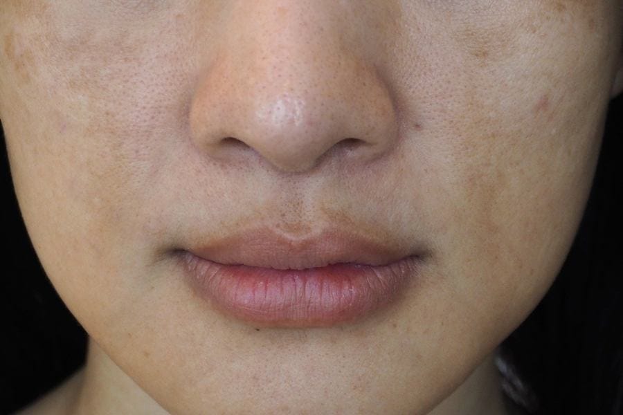 What is melasma around the mouth?