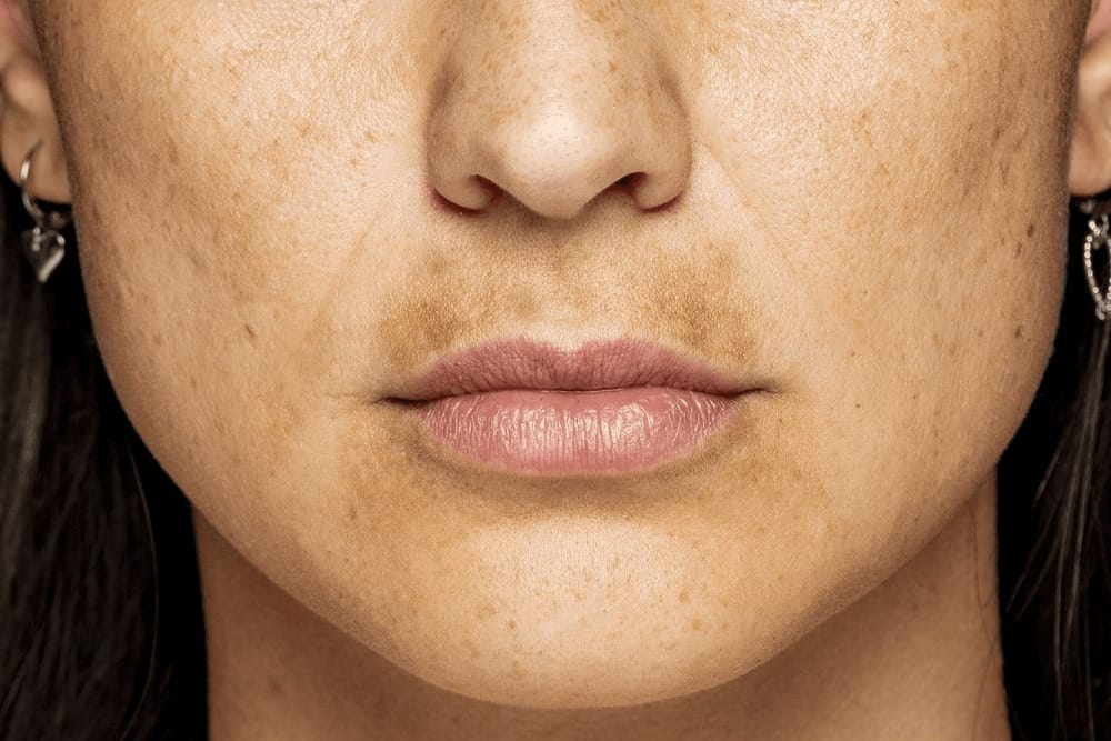 Signs of melasma around the mouth