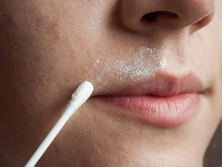 Use topical melasma treatment products