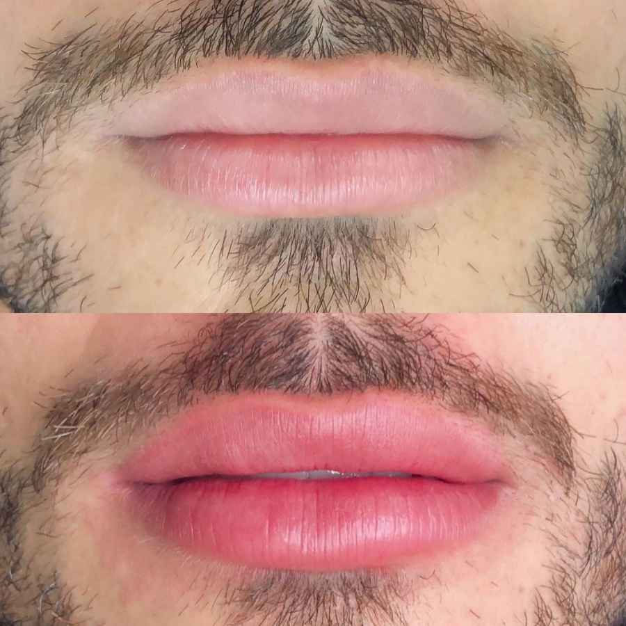 How to Prevent Dark Lips for Men