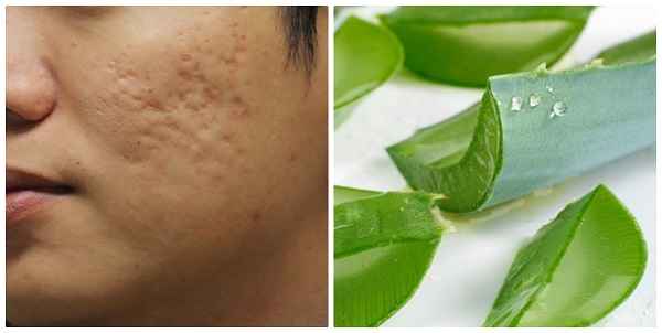 Cách làm mờ vết thâm sẹo bằng nha đam