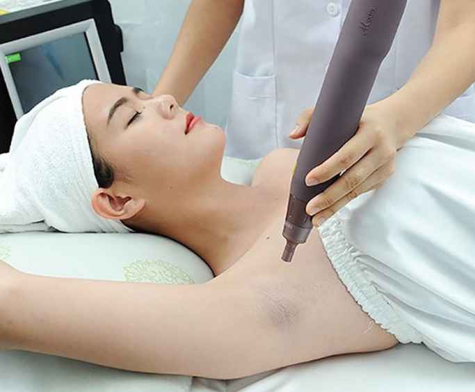 How to treat dark armpits with laser technology