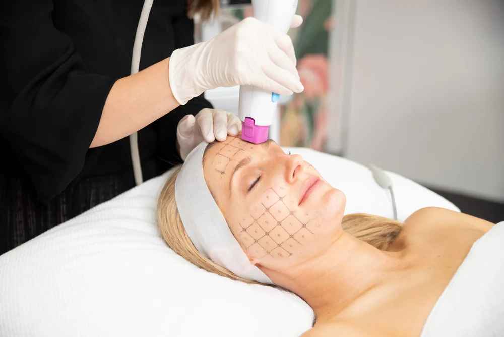 Công nghệ Thermage