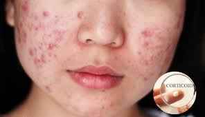 Corticoid là gì? Vì sao da bị nhiễm corticoid?
