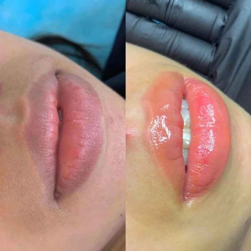 Trusted Lip Darkening Removal Clinic