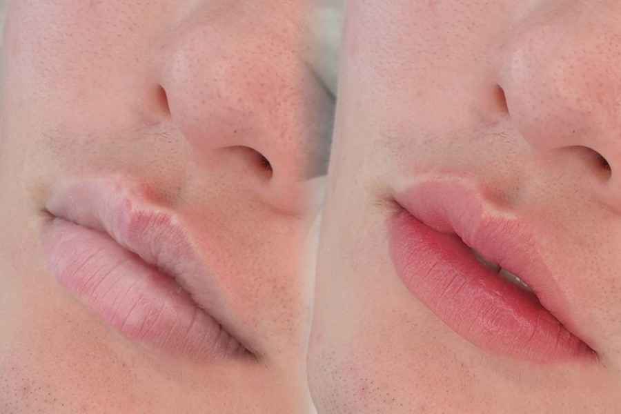 Trusted Dark Lip Removal Clinics