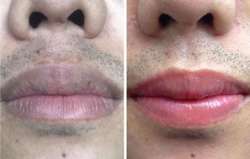 Price of Dark Lip Removal for Men