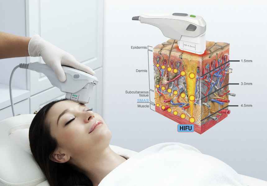 HIFU – Facial Lifting from Deep Within