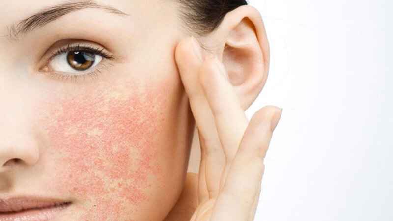 Hướng dẫn cách thải độc da mặt bị nhiễm corticoid tại nhà