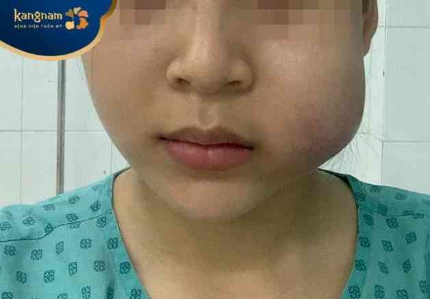 Lệch form, không đều màu hoặc thay đổi kết cấu da