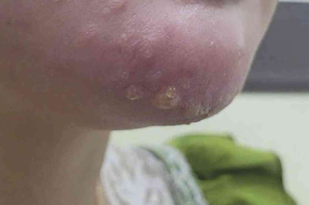 Nguy cơ nhiễm trùng
