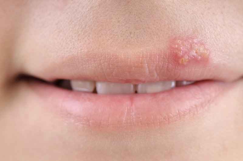 Causes of lip filler injection blisters