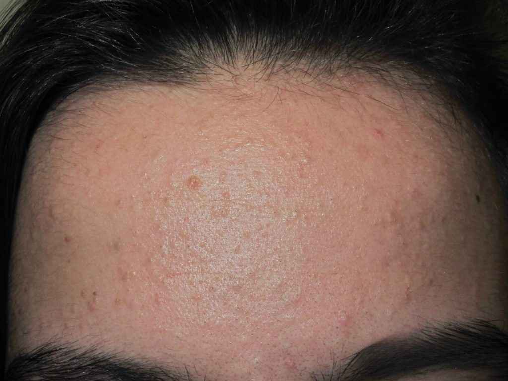 Common Causes of Hidden Acne on Forehead