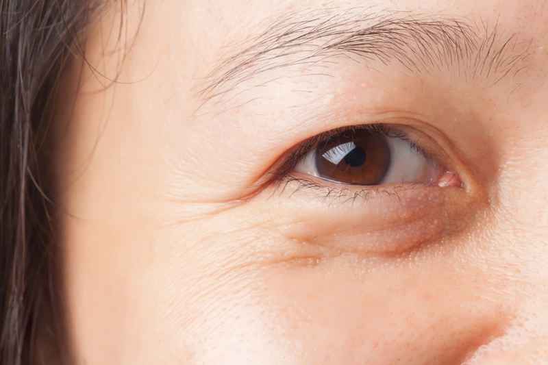 Nguyên nhân vùng da mắt bị lão hóa