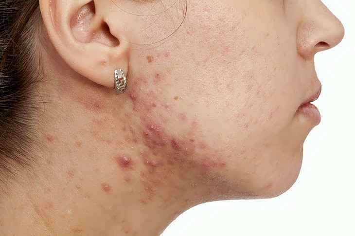 Causes of Jawline Acne