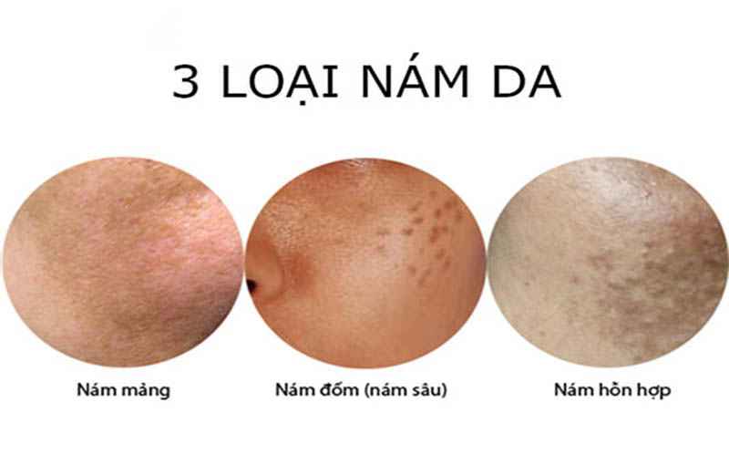 Common types of melasma