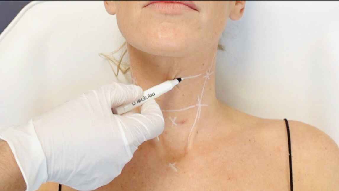 Tiêm Collagen trẻ hóa
