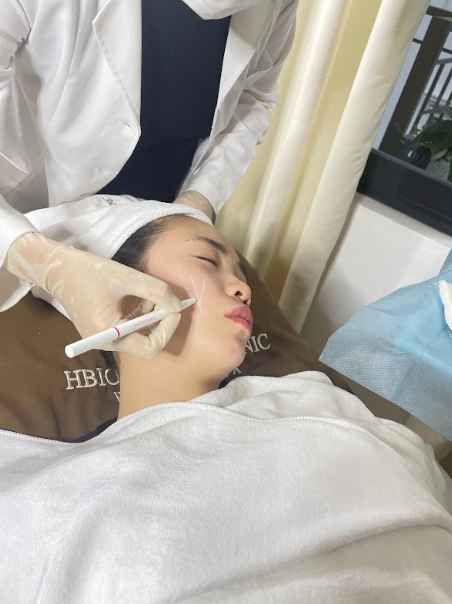 Tiêm filler bị nhức – Phải làm sao?