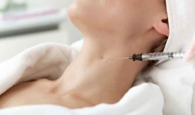 Tiêm Filler trẻ hóa vùng cổ