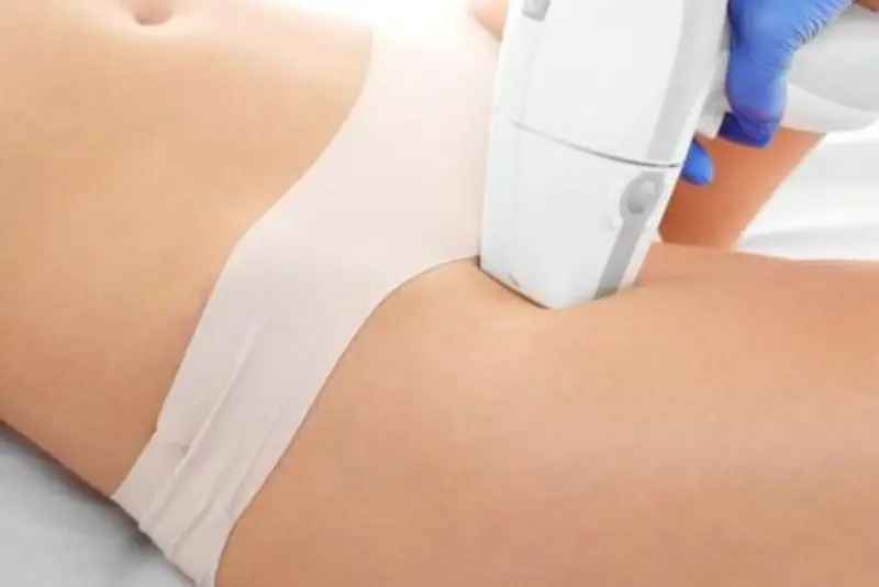 Triệt lông vùng kín bằng laser