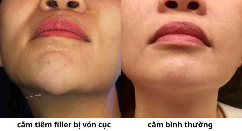 Vón cục và tạo u cứng dưới da