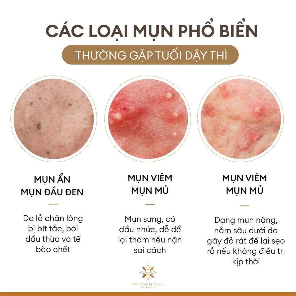 1 liệu trình trị mụn là bao lâu tùy theo mức độ da