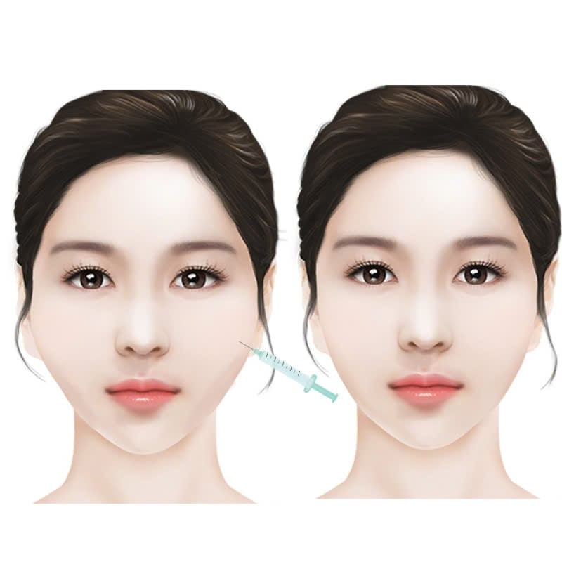 Ai nên tiêm filler hạ gò má?