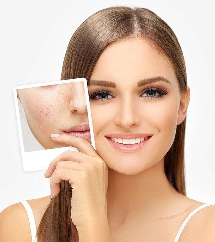 Allantoin phù hợp với nhạy cảm, mụn