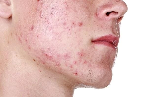 Các bước chăm sóc da dầu mụn