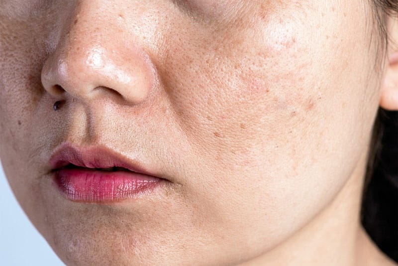 Các bước chăm sóc da mặt bị nám