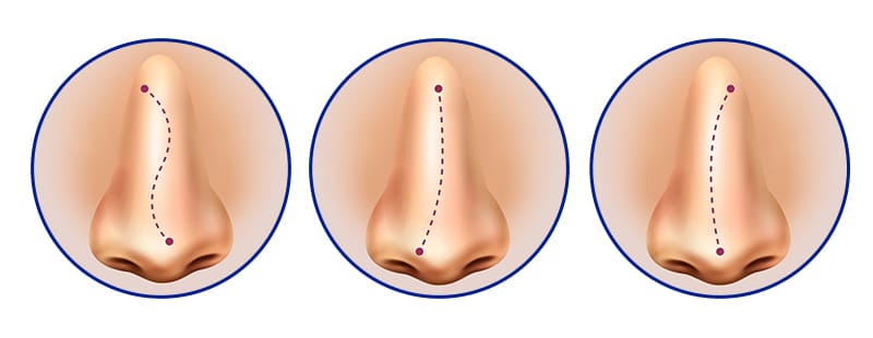 Các kiểu mũi lệch thường gặp