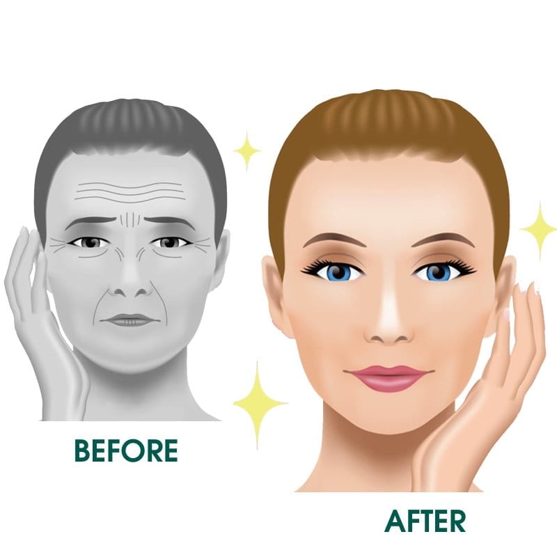 Căng da thái dương bao lâu thì đẹp?