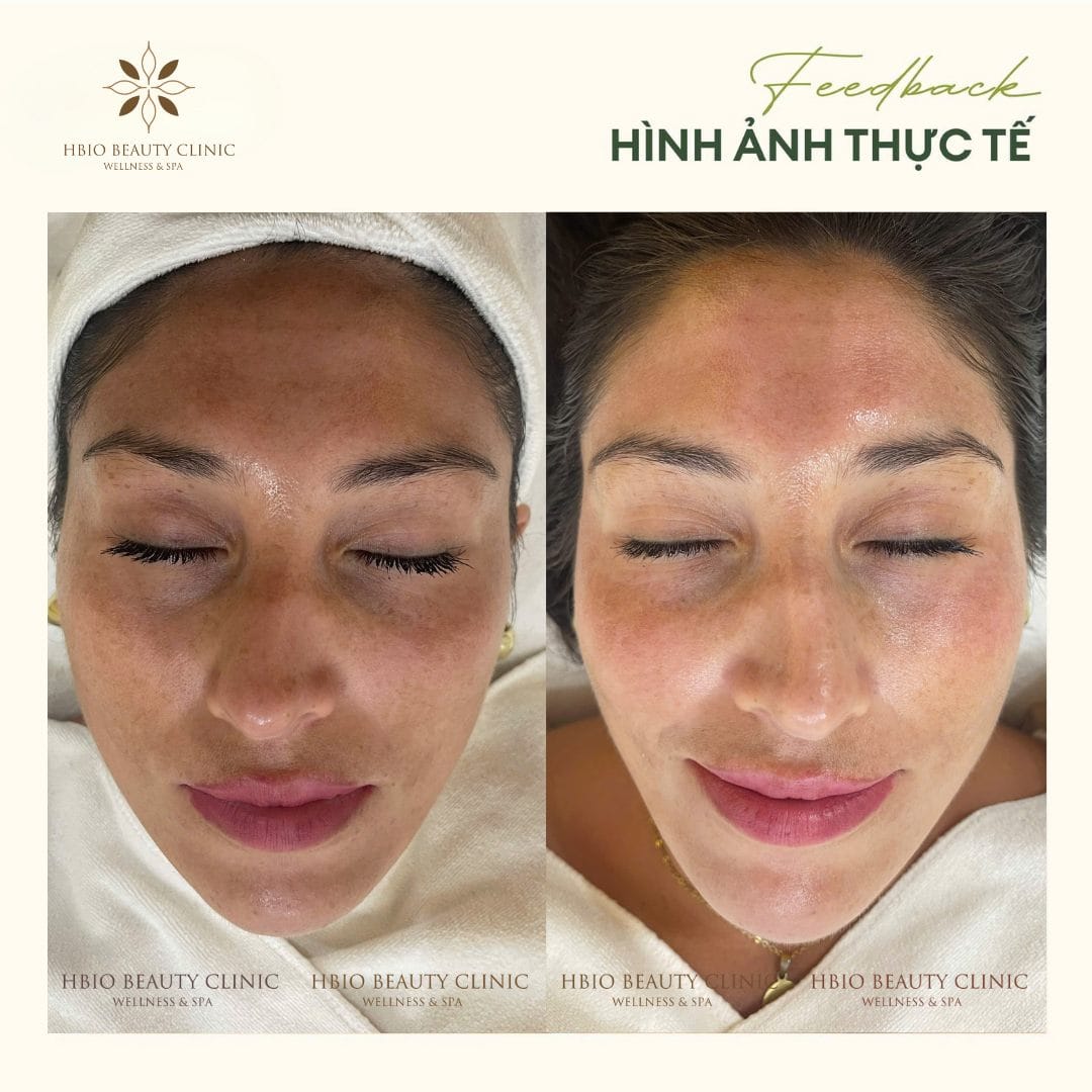 Cấp ẩm tức thì, phục hồi làn da khô, bong tróc, sần sùi