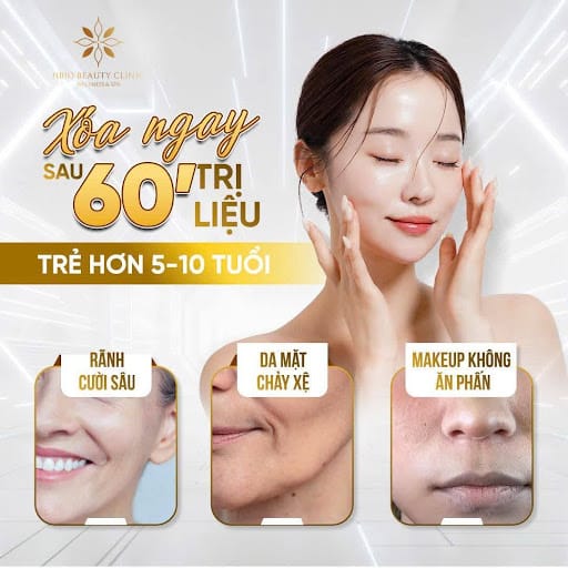 Chi phí tiêm filler rãnh cười bao nhiêu cc