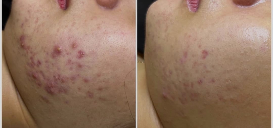 Da bị viêm mẩn đỏ khi mất hàng rào bảo vệ