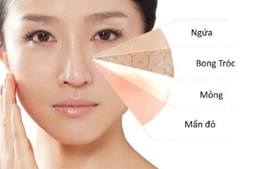 Da dễ bắt nắng, cháy nắng