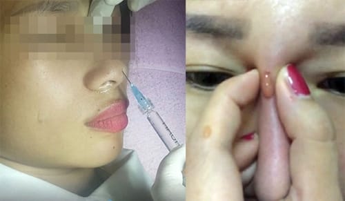 Have had complications with fillers that have not been completely treated